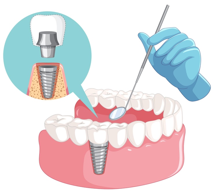 ABOUT DENTAL IMPLANTS IN REIDSVILLE, NC