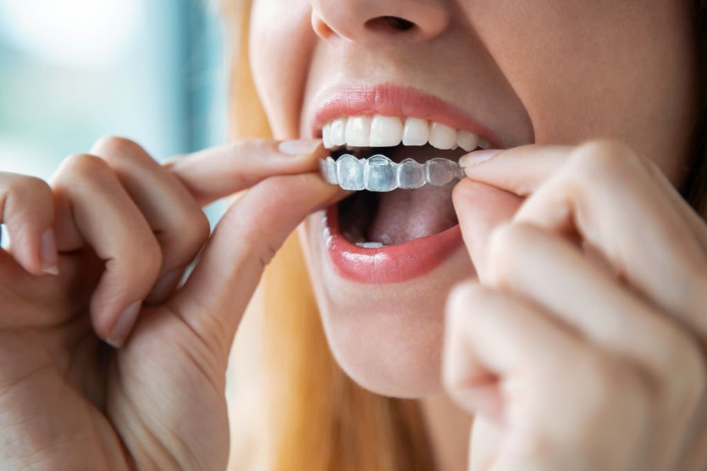 Get More Confident Smile With Invisalign