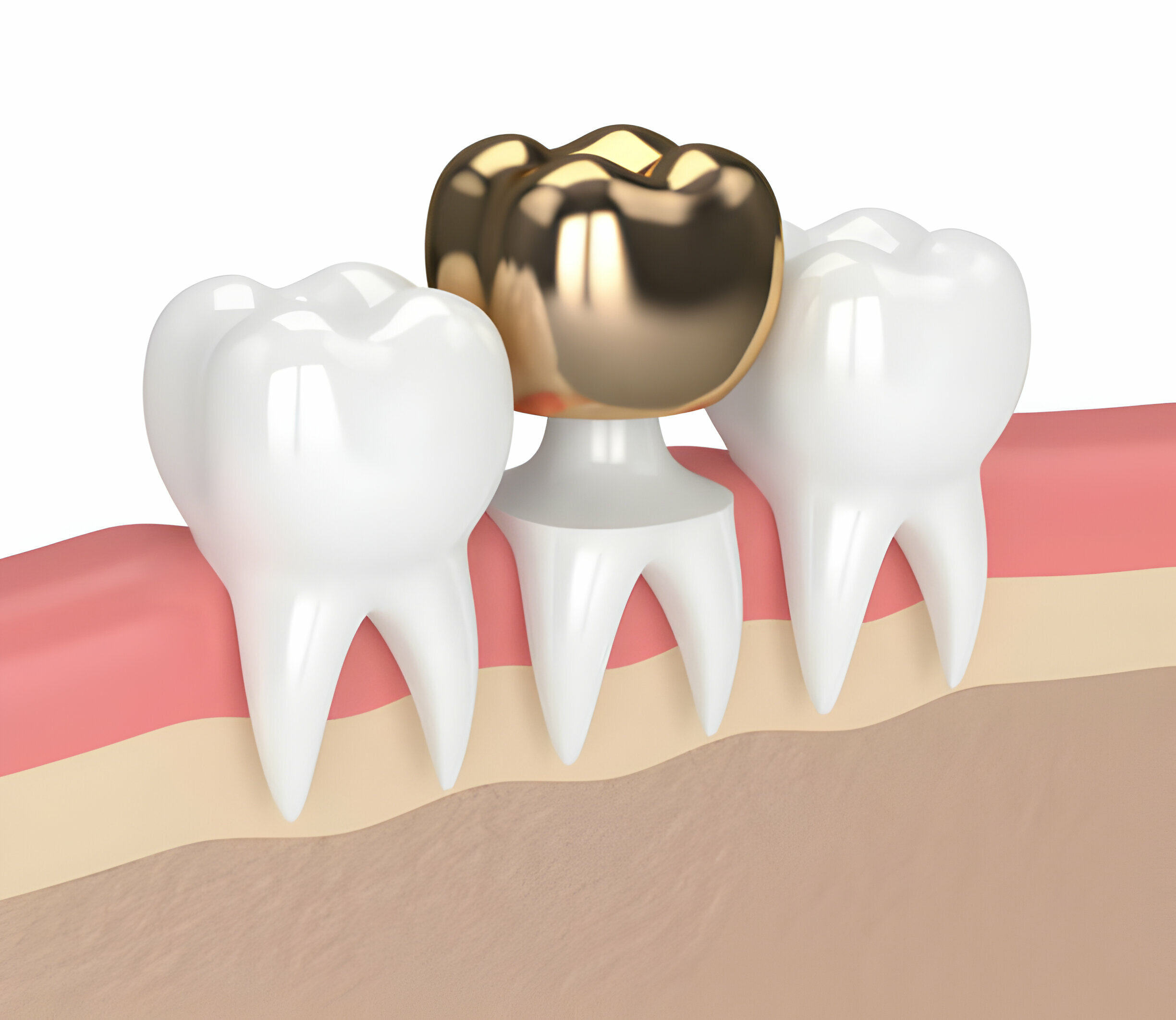 Your Ultimate Guide to Fillings by a Composite Fillings Dentist_FI