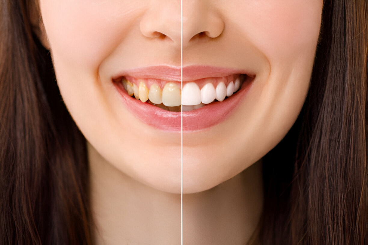 Brighten Your Smile with Professional Teeth Whitening – Trusted Dentist in Reidsville, NC at Caring Modern Dentistry_FI