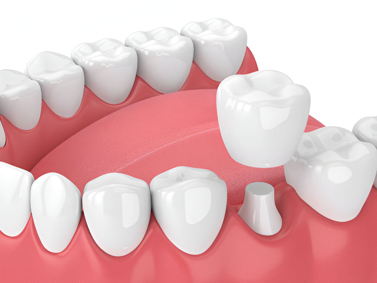 How Long Do Dental Crowns Last? Tips for Maintaining Your Crowns in Reidsville, NC